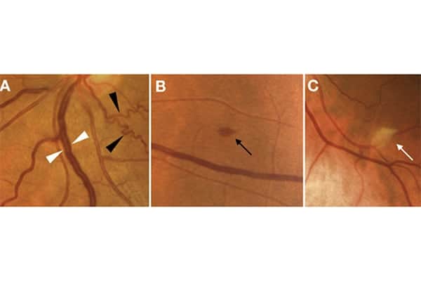 mal aux yeux apres covid oeil covid ophtalmo paris 4 docteur camille rambaud ophtalmologiste specialiste chirurgie refractive paris