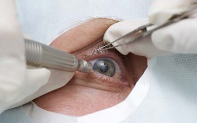Chirurgie réfractive et cataracte