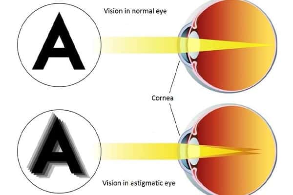 astigmatisme test myope astigmate ophtalmo paris docteur camille rambaud ophtalmologiste specialiste chirurgie refractive paris