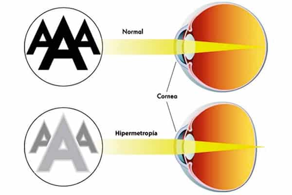 hypermetropie et presbytie hypermetropie c est quoi ophtalmo paris docteur camille rambaud ophtalmologiste specialiste chirurgie refractive paris