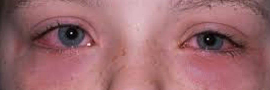 urgences yeux paris urgence ophtalmologique paris ophtalmo paris docteur camille rambaud ophtalmologiste specialiste chirurgie refractive paris