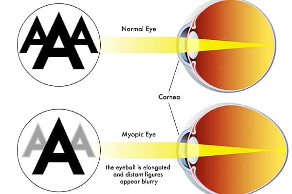 vision floue de loin et de pres astigmatisme myopique compose ophtalmo paris docteur camille rambaud ophtalmologiste specialiste chirurgie refractive paris