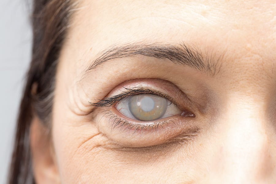 laser apres operation de la cataracte ophtalmologiste specialiste chirurgie refractive cataracte paris dr camille rambaud