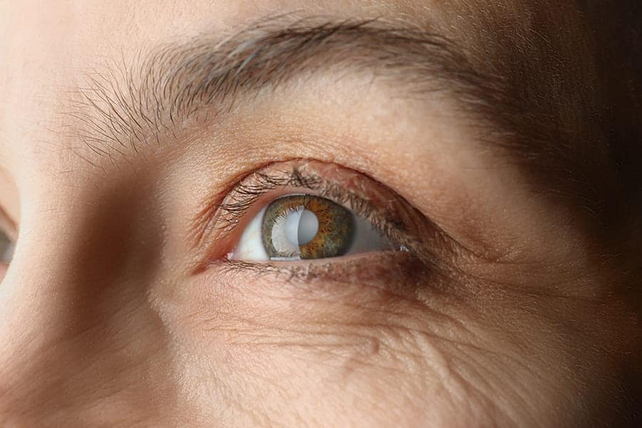 cataracte symptomes prevention causes chirurgien ophtalmologue paris dr camille rambaud cataracte symptomes prevention causes chirurgien ophtalmologue paris dr camille rambaud