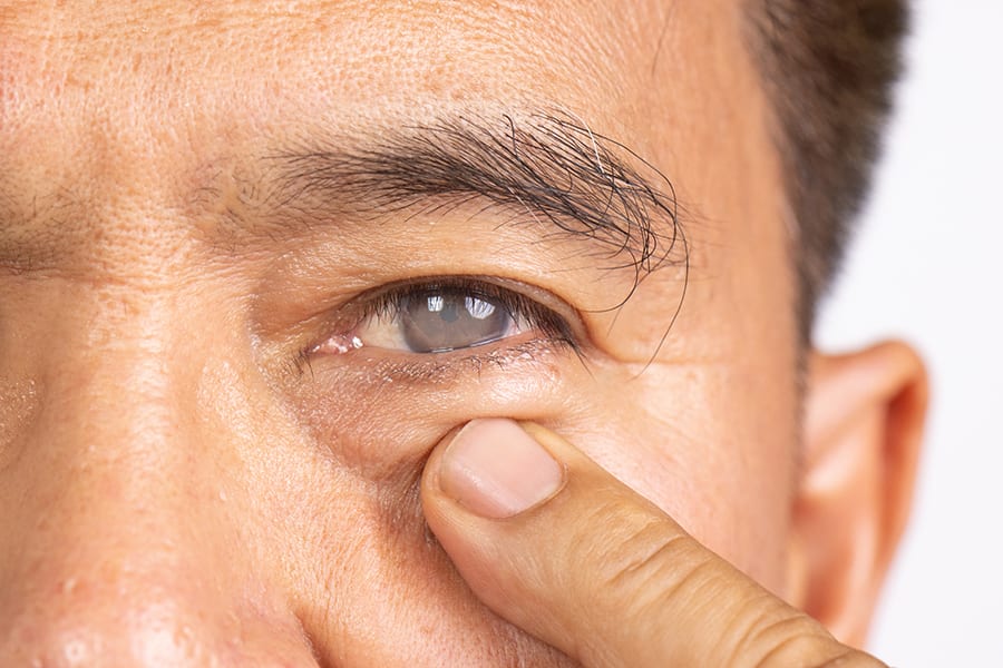 operation cataracte douleur combien temps gene effets secondaires operation cataracte chirurgien ophtalmologue paris dr camille rambaud operation cataracte douleur combien temps gene effets secondaires operation cataracte chirurgien ophtalmologue paris dr camille rambaud